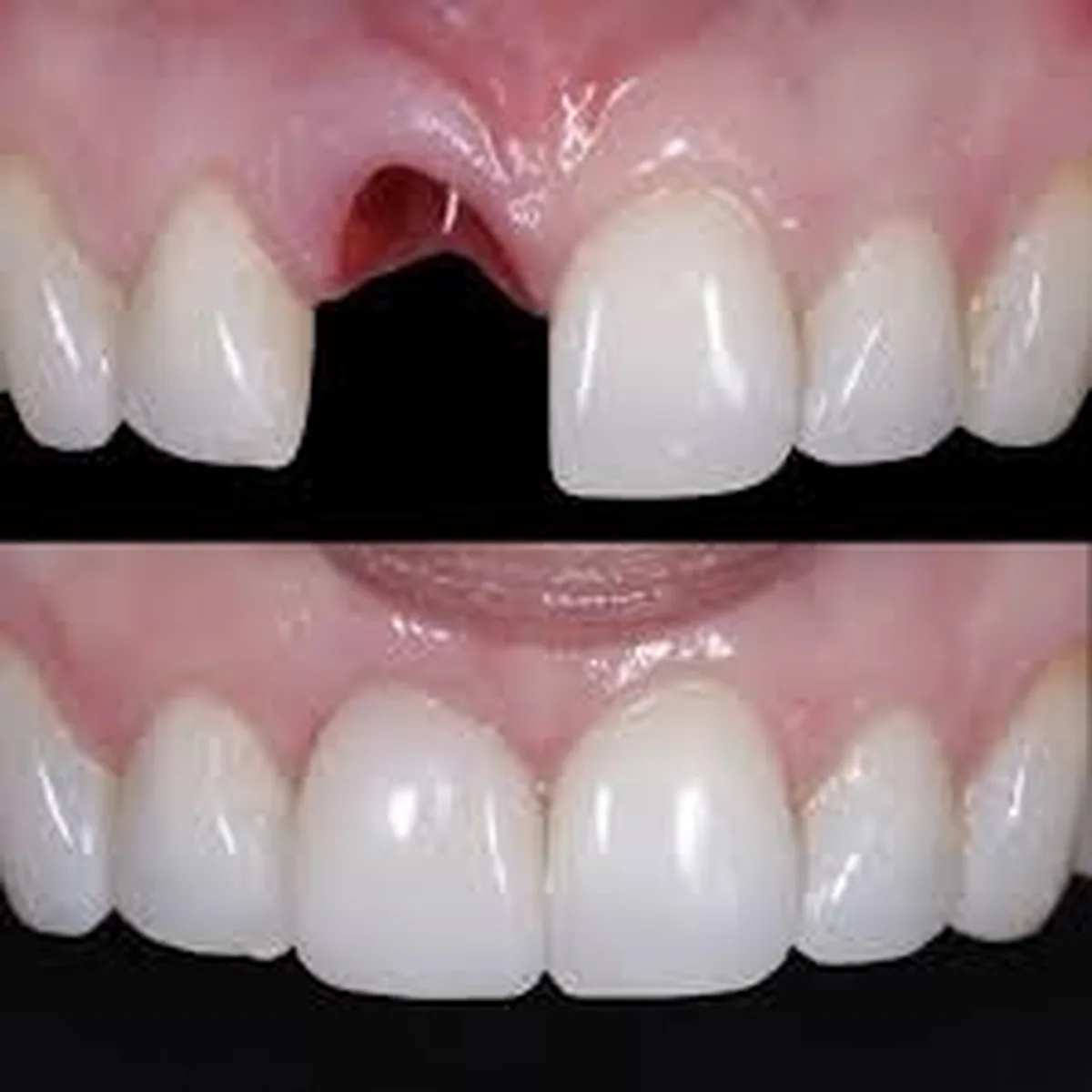 Ilustração do procedimento: Implante dentário