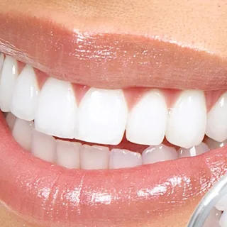 Ilustração do procedimento: Odontologia estética