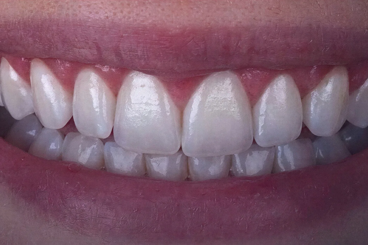 Ilustração do procedimento: Plástica periodontal